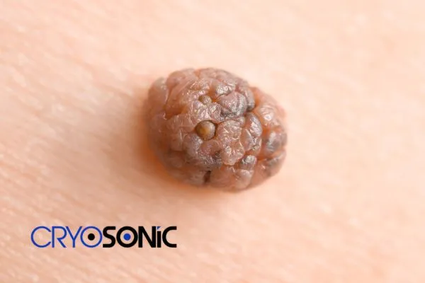 Cryopen the Safest Mole Removal Treatment Eccles