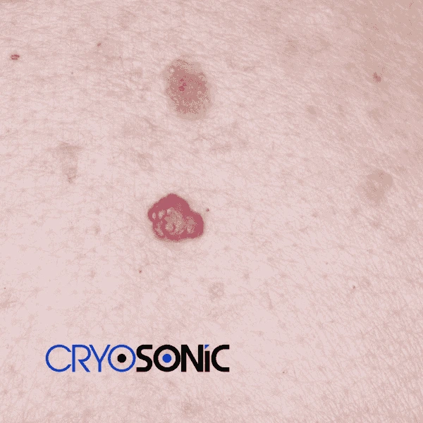 Looking for pain free cherry angioma removal treatment Eccles? Call our team today! Eccles