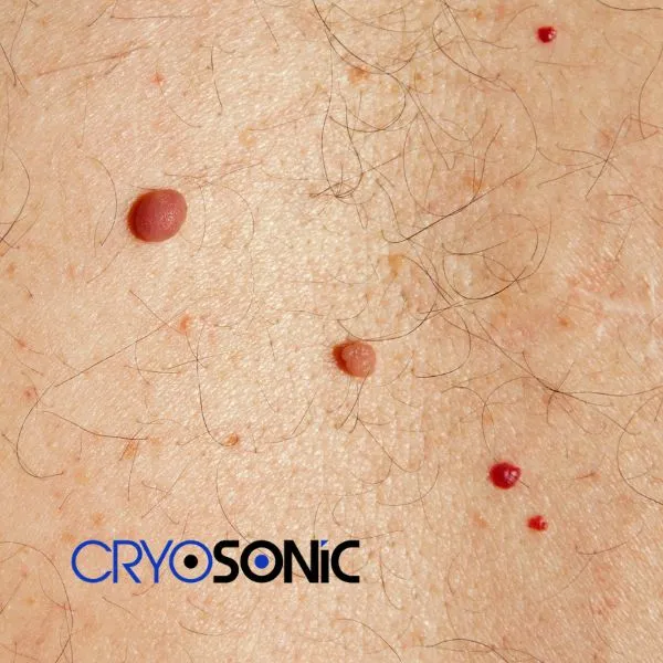 get cherry angioma removal treatment today! Eccles
