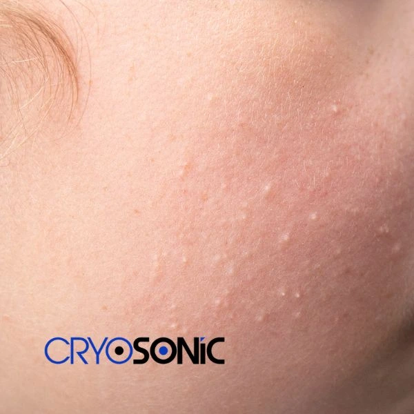 Are you looking for milia removal treatment? Contact our team today Eccles