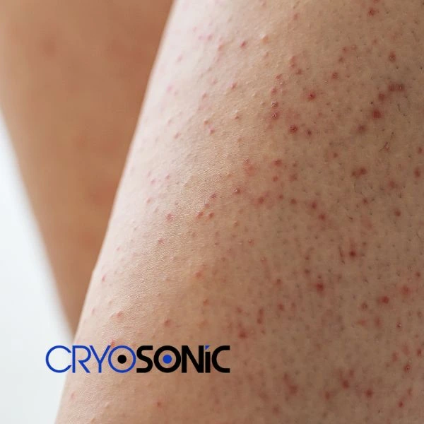 Looking for Seborrhoeic Keratosis removal Eccles treatment? Call our consultants today in Eccles