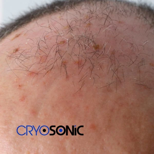 Access Seborrhoeic Keratosis removal from the comfort of your own home! Call us today in Eccles