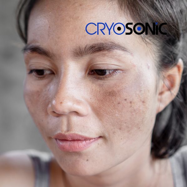 Ready to start age spots removal? Contact our team today in Eccles