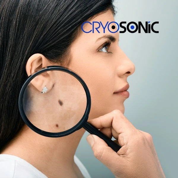 Do you want to learn more about benign moles removal treatment? Call our team today Eccles