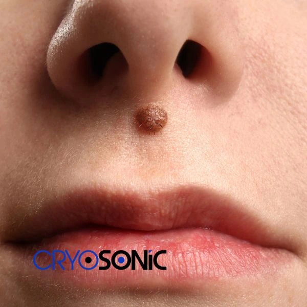 Start your benign moles removal treatment today Eccles