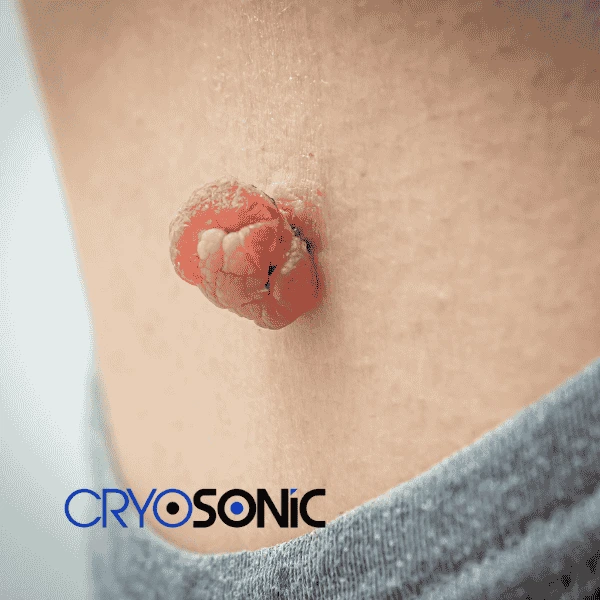 Book your skin tags removal Eccles from comfort of your own home! Eccles
