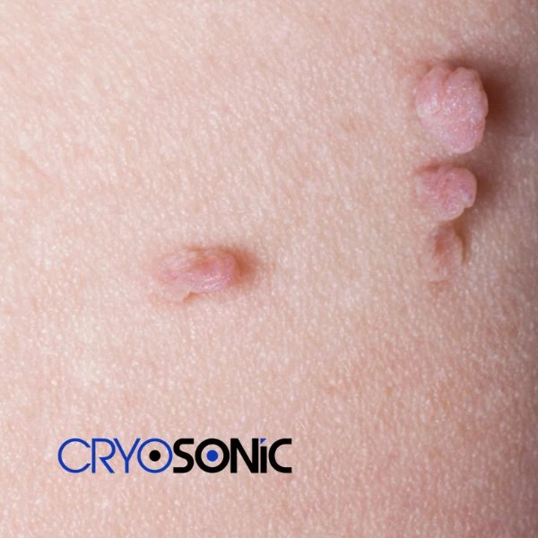 Are you looking for fast effect skin tag removal Eccles? Book in NOW! Eccles