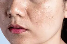 When will I see the results? Understanding healing, scabbing, scar prevention, and pigmentation changes Eccles