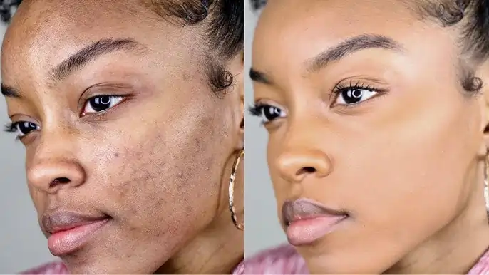 FAQs About Cryotherapy Healing, Scabbing & Pigmentation Changes Eccles