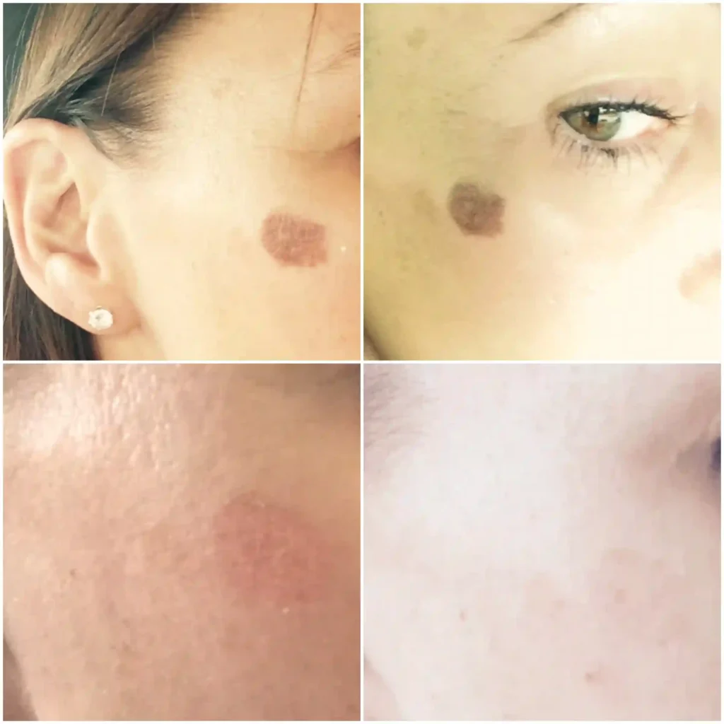 How long do pigmentation changes usually take to fade Eccles