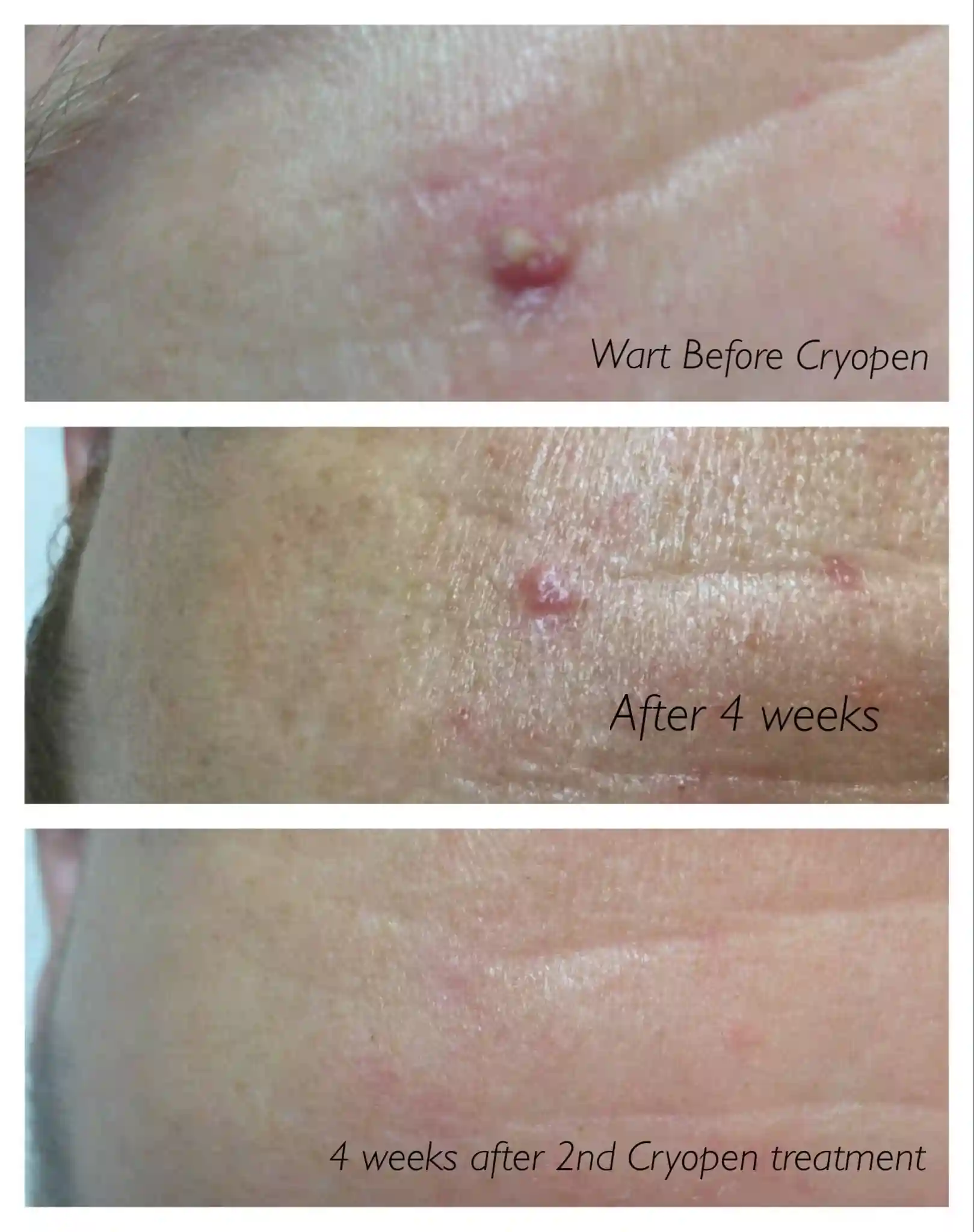 What early healing signs should I expect immediately after treatment Eccles