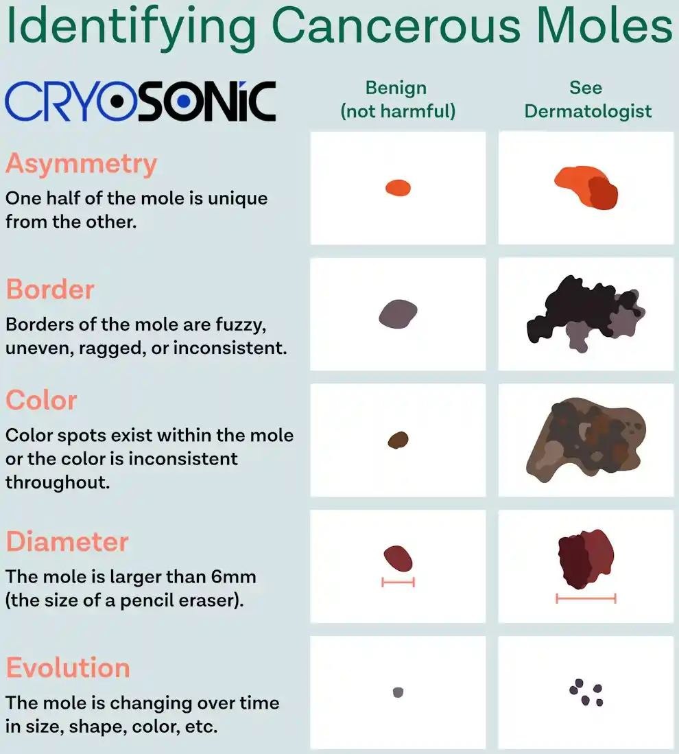 You Can’t Tell If a Mole Is Cancerous — But a Professional Can Eccles