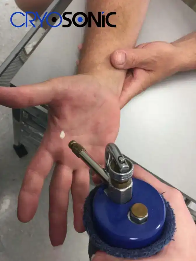 Temperature Differences: OTC vs Medical-Grade Cryotherapy Eccles
